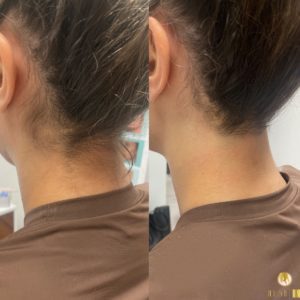 woman's neck laser hair removal