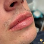 Lip Filler on a man