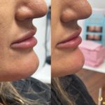 Women's Chin Filler