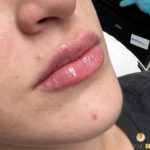 Lip augmentation after results