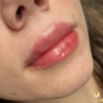 lip augmentation services Los Angeles