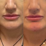 lip fillers before/after results