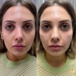 facial balancing Los Angeles