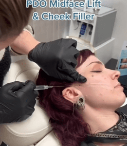 Hush L.A. Medspa - 🧵 Lifting the tip of the nose can make the