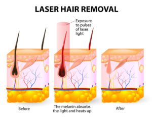 Laser hair removal before-after