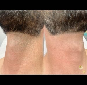 Laser hair treatment on a man's neck