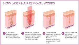 Laser hair removal treatment Los Angeles