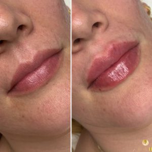 Lip Dermal Filler