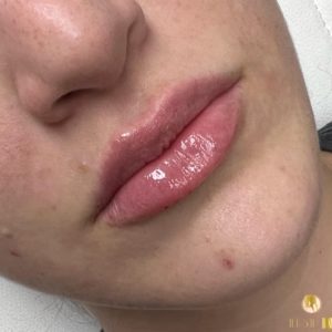 Lip filler