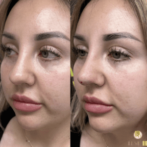 Hush L.A. Medspa - 🧵 Lifting the tip of the nose can make the nose appear  slimmer and more contoured. 🧵 We use PDO threads customized especially for  the nose to lift