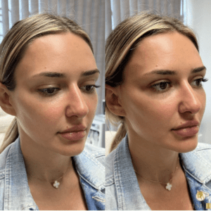 Hush L.A. Medspa - 🧵 Lifting the tip of the nose can make the nose appear  slimmer and more contoured. 🧵 We use PDO threads customized especially for  the nose to lift