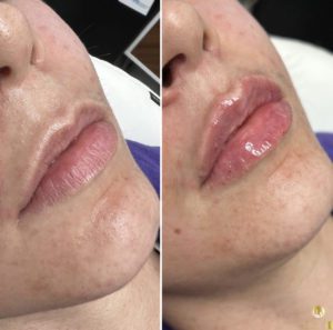 dermal filler for lips