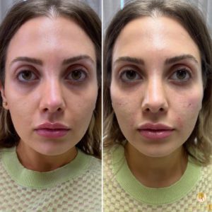 face and lips dermal filler