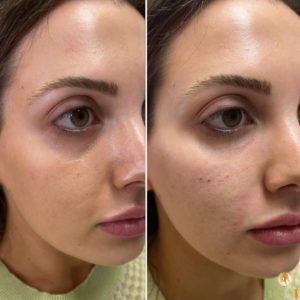 face dermal filler