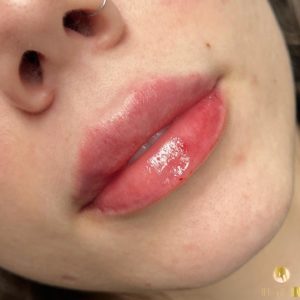full lips with Dermal filler