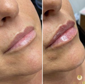 lips dermal filler in Los Angeles