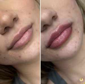 lips dermal filler for women