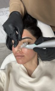 Microneedling treatment Los Angeles