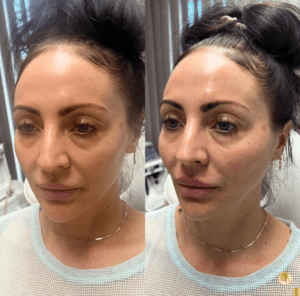 mid face lift with PDO & defined cheekbones