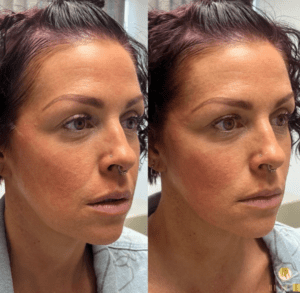 mid face lift with PDO thread lifts Los Angeles