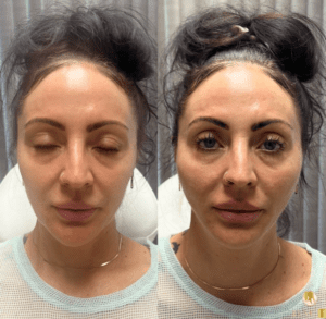 more volume and defined cheekbones with PDO lift