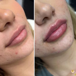 women lips filler