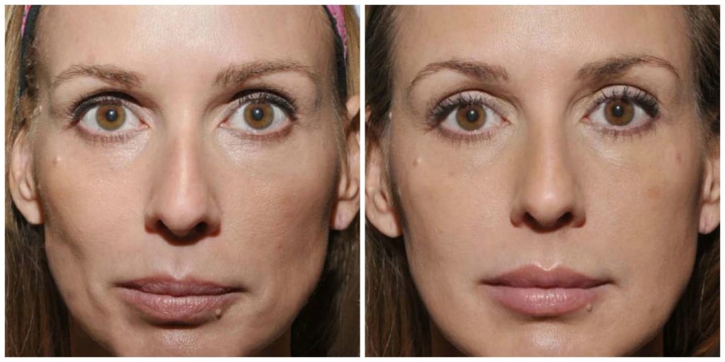 Before-after of Sculptra