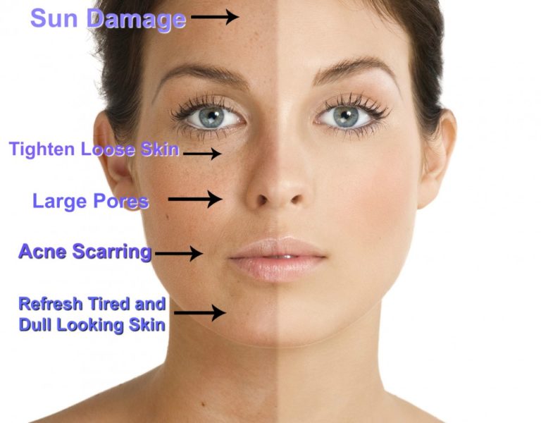 Chemical peel dermatology