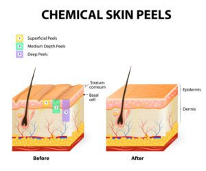 chemical peels