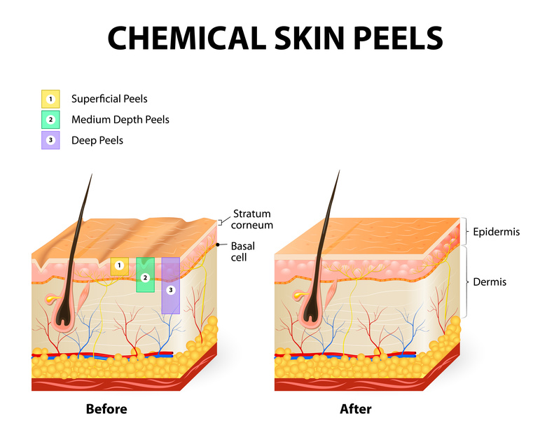 chemical peels