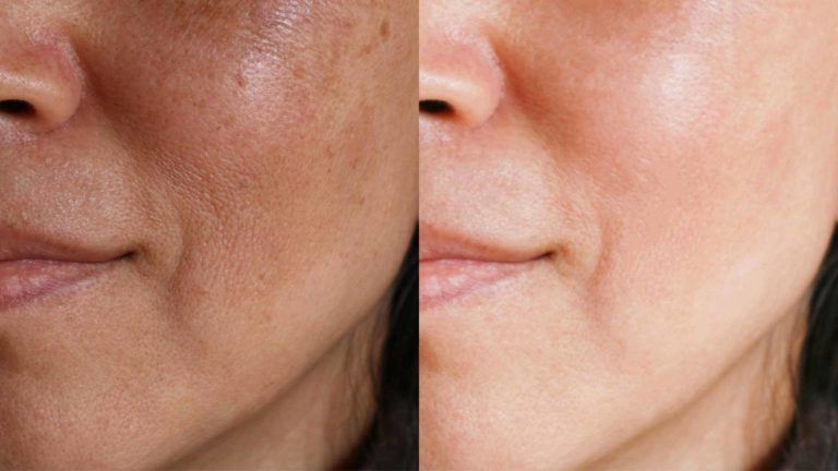Chemical peels before-after