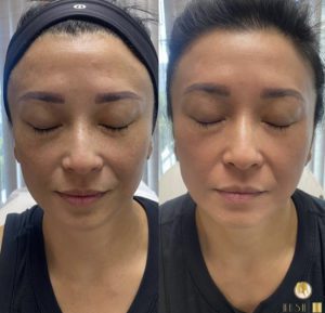 Chemical peels Los Angeles before and after