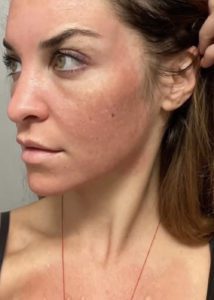 Cosmelan peel los angeles before and after