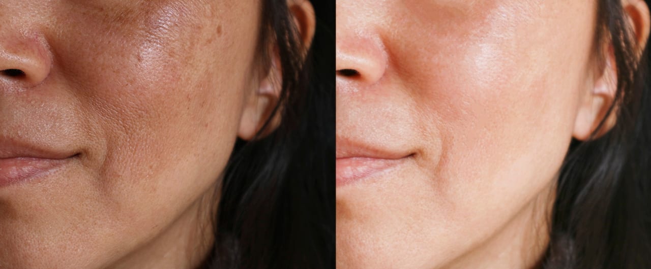 How does IPL photofacial work age spots treatment with Lumecca