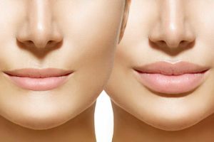 Dermal Filler injections Los Angeles