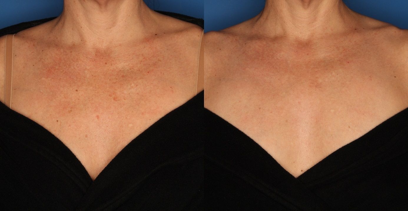 Lumecca treatment before-after