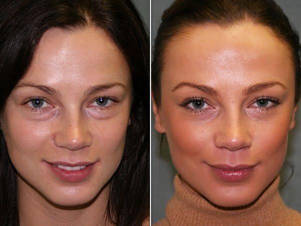 PRP vampire facelift before-after