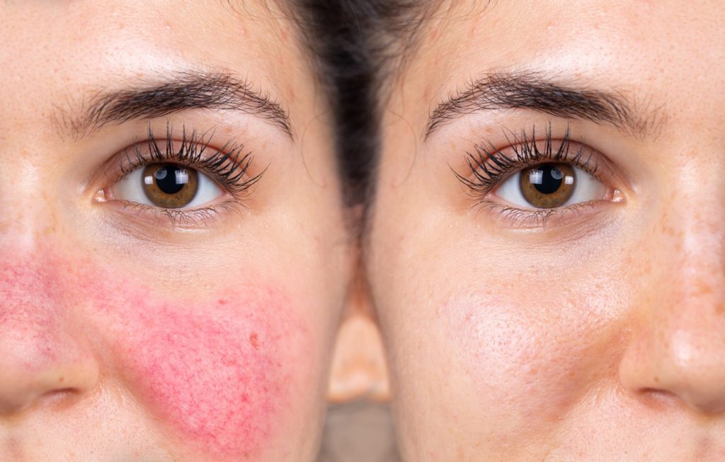 Rosacea treatment with Lumecca IPL photofacial