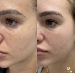 chemical peel treatment