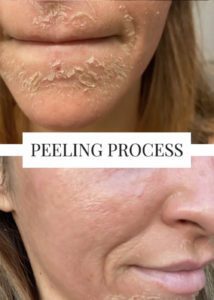 cosmelan peel los angeles peeling progress