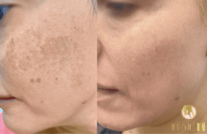 pigmentation removal Los Angeles