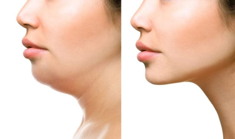 thread lift for non surgical facelifts