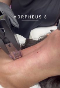 Body and face Morpheus8 treatment
