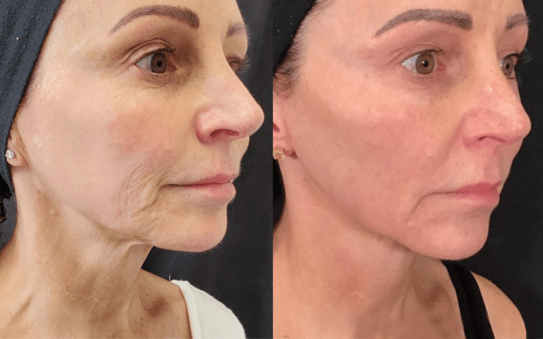 MORPHEUS8 facial before and after Los Angeles