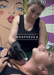 Morpheus8 on neck Los Angeles