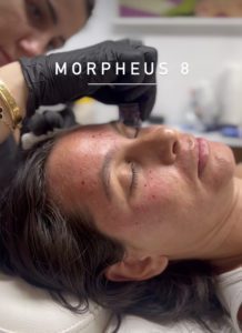 Morpheus8 treatment Los Angeles