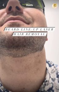 beard laser hair removal