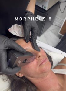 Buffalo hump treatment with Morpheus 8 - Hush LA Medspa