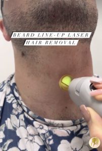 laser hair removal for men