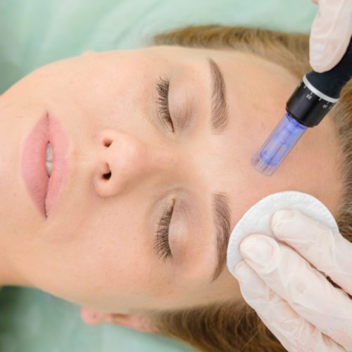 microneedling treatment in Los Angeles